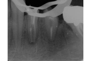Eseguiti i ritrattamento endodontici