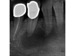Guarigione di estesa lesione endodontica
